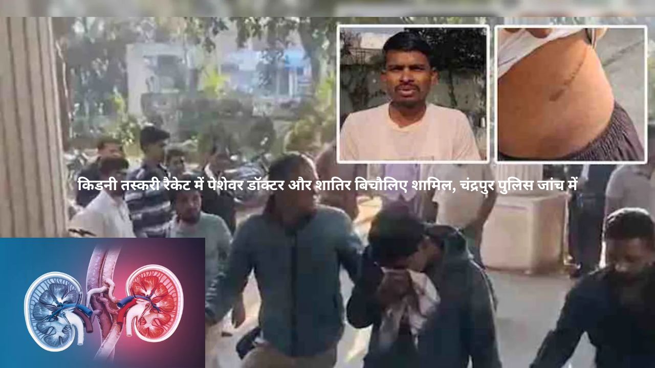 Kidney Trafficking Racket का खुलासा : गरीब दाताओं का शोषण कर अमीर मरीजों से वसूले 50-80 लाख रुपए