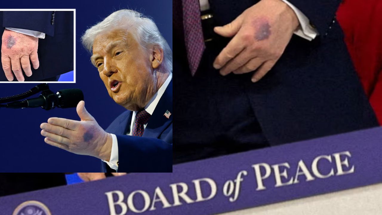 दावोस 2026: Trump के हाथ पर नीला जख्म, जानें हादसे और एस्पिरिन का सच