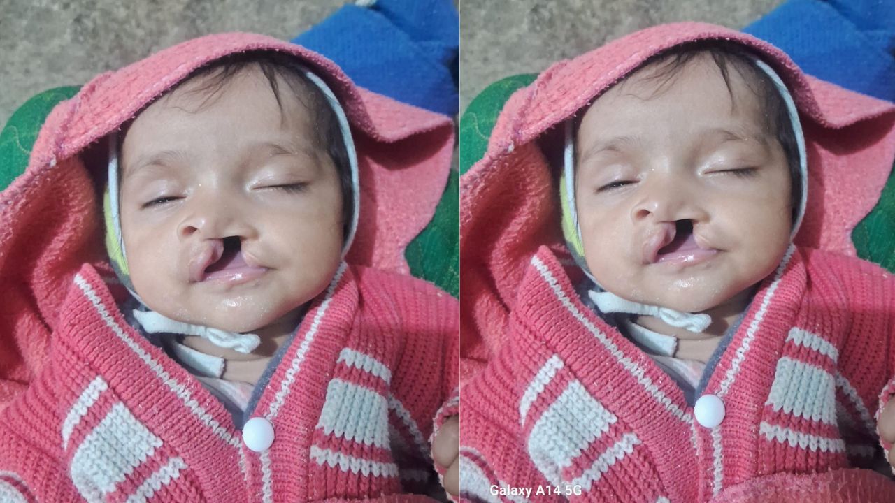 Free Cleft Lip and Palate Surgery Camp for Children in Indore on February 8