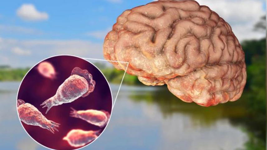 Surat Shock: Woman Develops Brain Fungal Infection After Smelling Vegetables