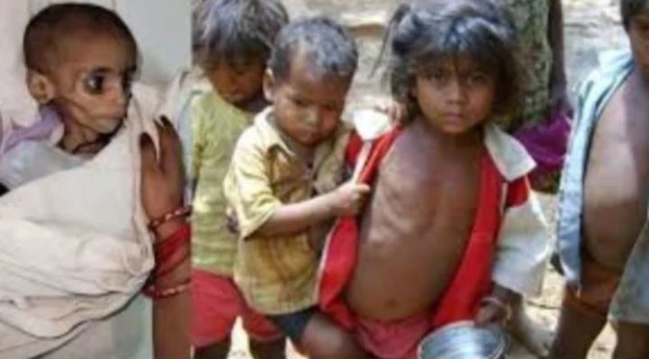 MP Child Malnutrition Crisis: NFHS-6 रिपोर्ट में मध्यप्रदेश की चिंता बढ़ी, कुपोषण के आंकड़ों में बढ़ोतरी