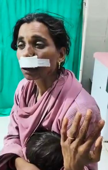 Dewas में रिश्ते हुए शर्मसार: प्रेम विवाह करने वाली महिला पर पति ने किया जानलेवा हमला