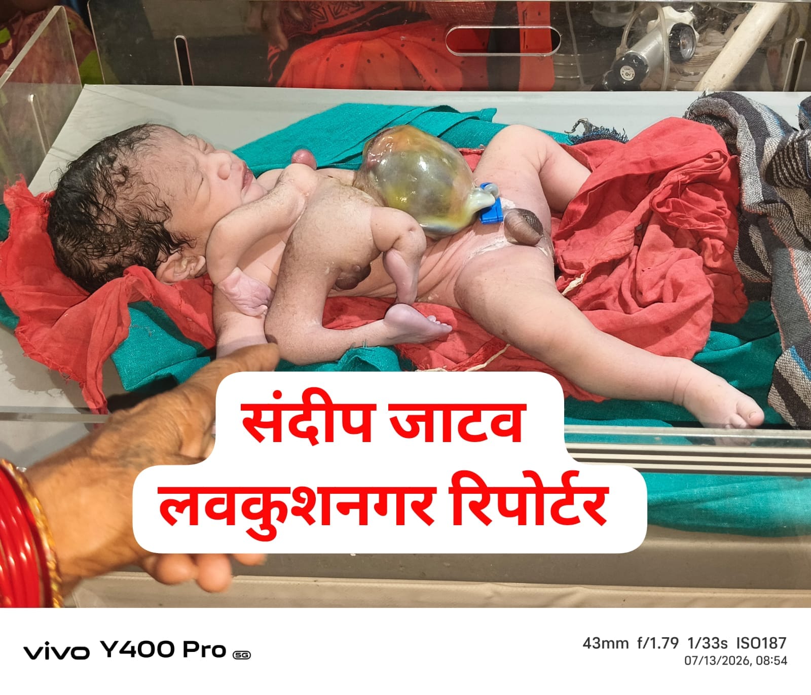 4 हाथ और 4 पैर वाले बच्चे का जन्म: छतरपुर में हैरान करने वाला मामला, डॉक्टरों ने बताई वजह