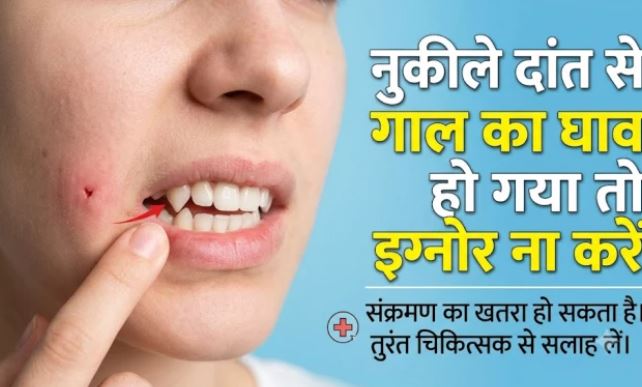 नुकीले दांत से गाल में बार-बार घाव हो तो न करें नजरअंदाज, संक्रमण से बढ़ सकती हैं स्वास्थ्य समस्याएं
